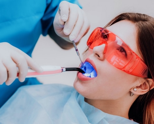 image showing dental sealant being applied