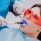 image showing dental sealant being applied